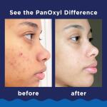 PanOxyl Acne Foaming Wash: 10% Benzoyl Peroxide, maximum strength, antimicrobial, 5.5 oz.